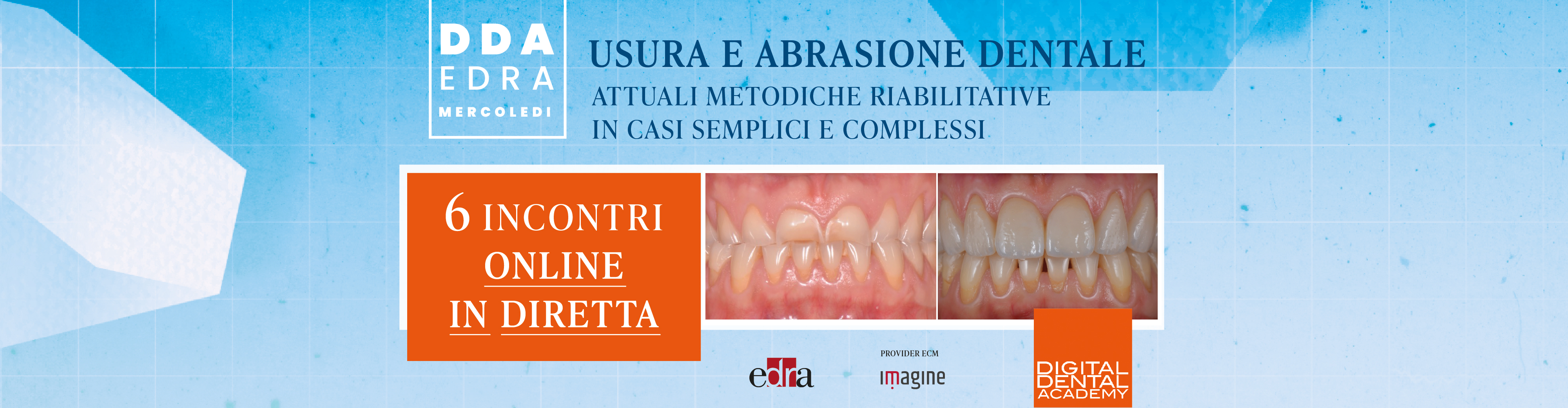 Usura e abrasione dentale: attuali metodiche riabilitative in casi semplici e complessi