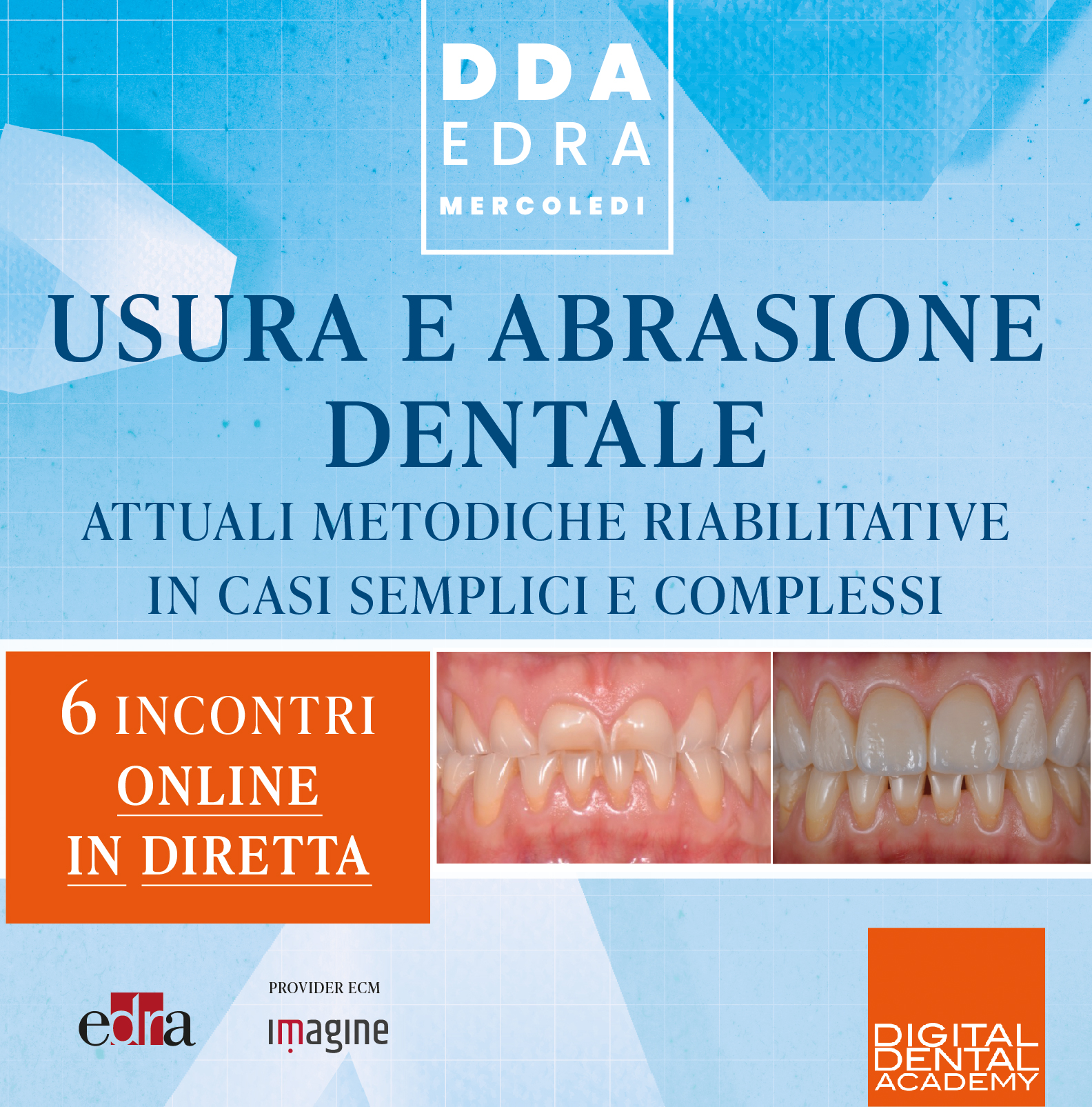 Usura e abrasione dentale: attuali metodiche riabilitative in casi semplici e complessi